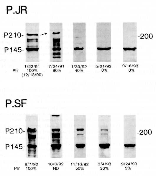 Blood Test for Ph Chromosome Leukemias