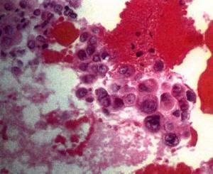 Malignant cells of adenocarcinoma