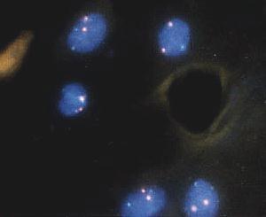 Chromosome 10 and 17