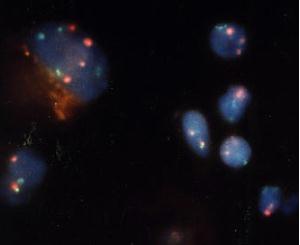 Chromosome 12 and 17